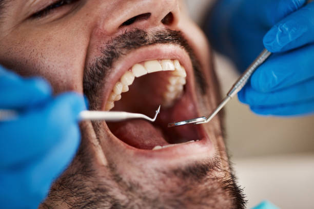 Best Emergency Tooth Extraction in Chevy Chase View, MD