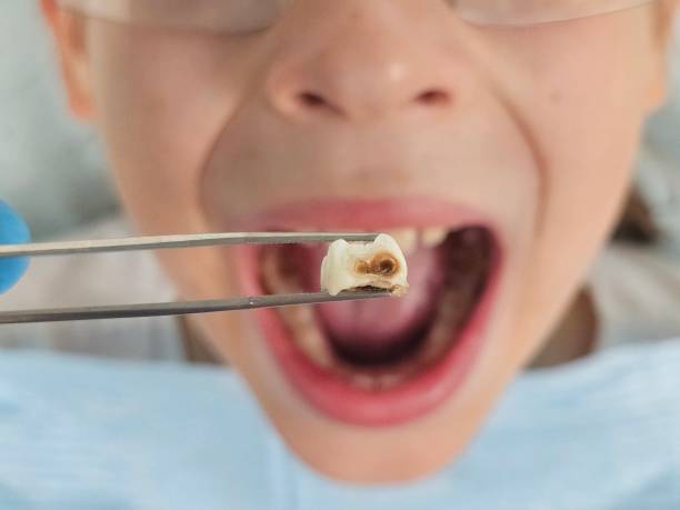 Best Emergency Root Canal Treatment in Chevy Chase View, MD